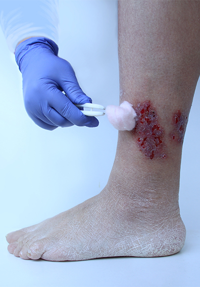 Understanding Diabetic Ulcers